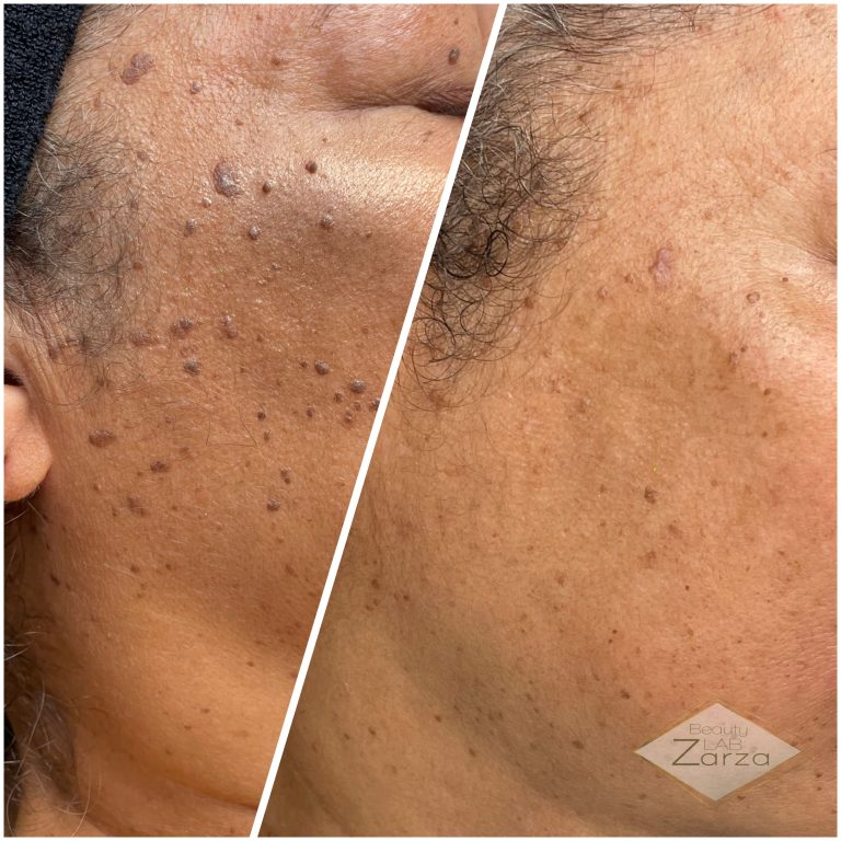 Voor en na: rode adertjes en steelwratjes bij Beauty Lab Zarza