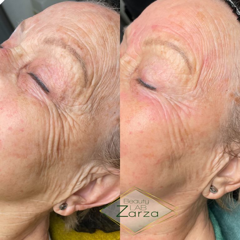Voor en na: microneedling bij Beauty Lab Zarza