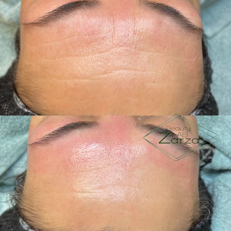 Voor en na: microneedling bij Beauty Lab Zarza