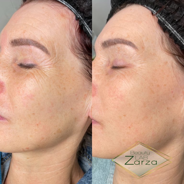 Voor en na: microneedling bij Beauty Lab Zarza