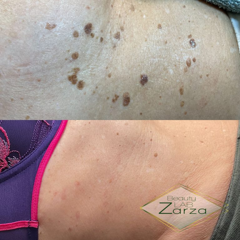 Voor en na: rode adertjes en steelwratjes bij Beauty Lab Zarza